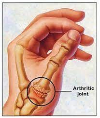 آرتروز مفصل مچ دست و انگشت شستآرتروز مفصل مچ دست و انگشت شست
