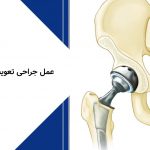 عمل جراحی تعویض مفصل لگن (total hip arthroplasty)