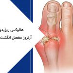 هالوکس ریژیدوس: آرتروز مفصل انگشت شست پا